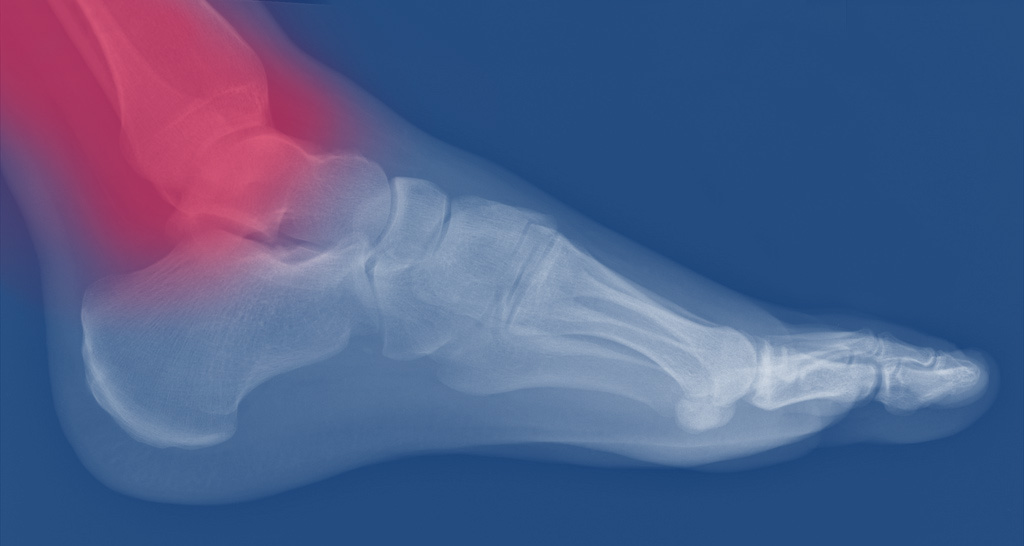 The Awful, Annoying Ankle Injury